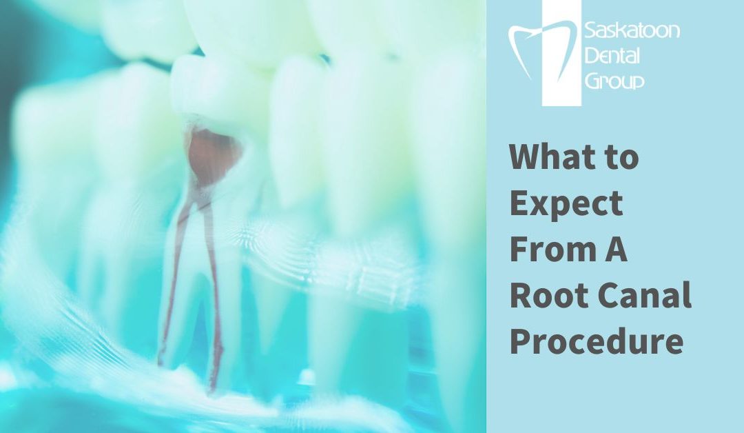 Xray for a Root Canal Procedure