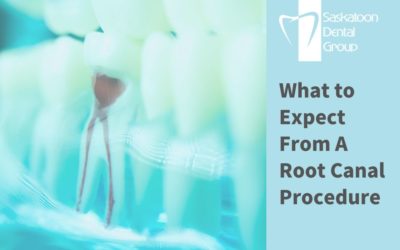 What to Expect From A Root Canal Procedure