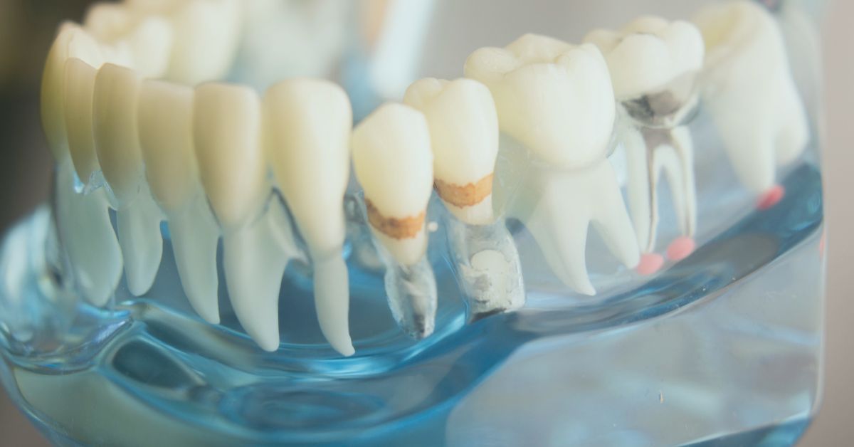 Picture of Teeth with Plaque on them - Saskatoon Dental Group