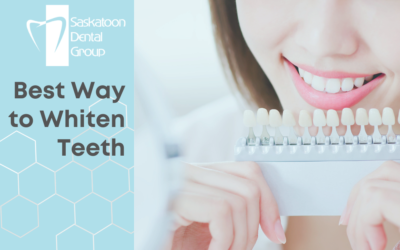 Best Way to Whiten Teeth