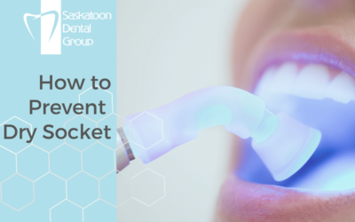 How to Prevent Dry Socket