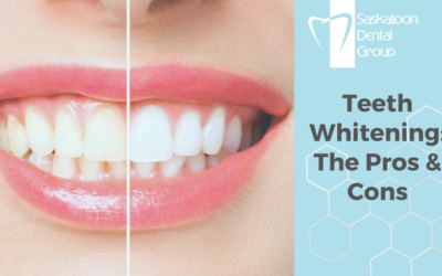 Teeth Whitening: The Pros & Cons