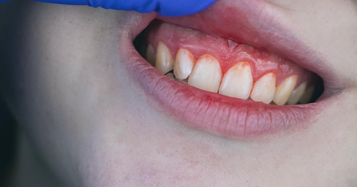 Picture of person's mouth with gums starting to recede.   Saskatoon Dental Group Patient